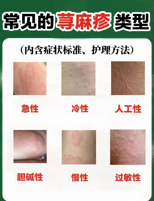 荨麻疹是不是风湿疙瘩