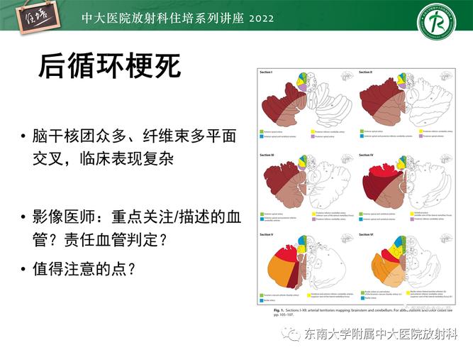脑梗后循环是什么症状