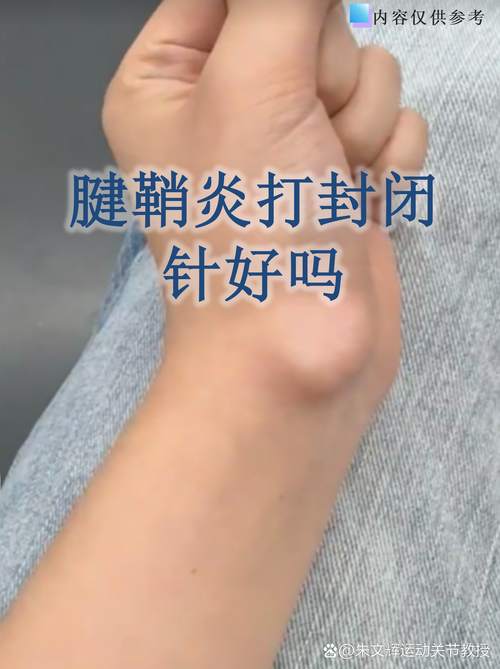 类风湿关节腔打什么针