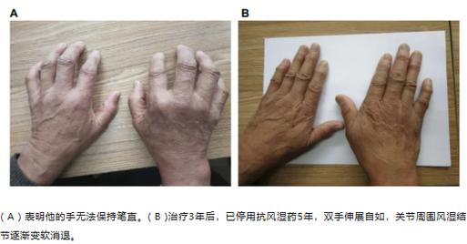 类风湿关节腔打什么针