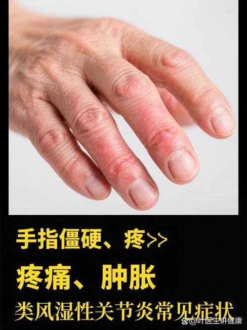 排除类风湿的手指晨僵