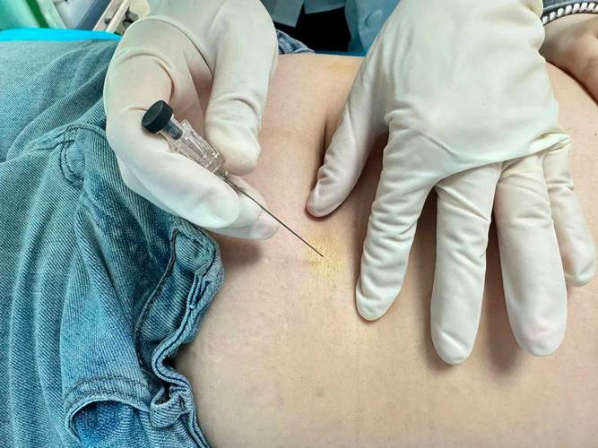 针灸 穴位埋线疗法