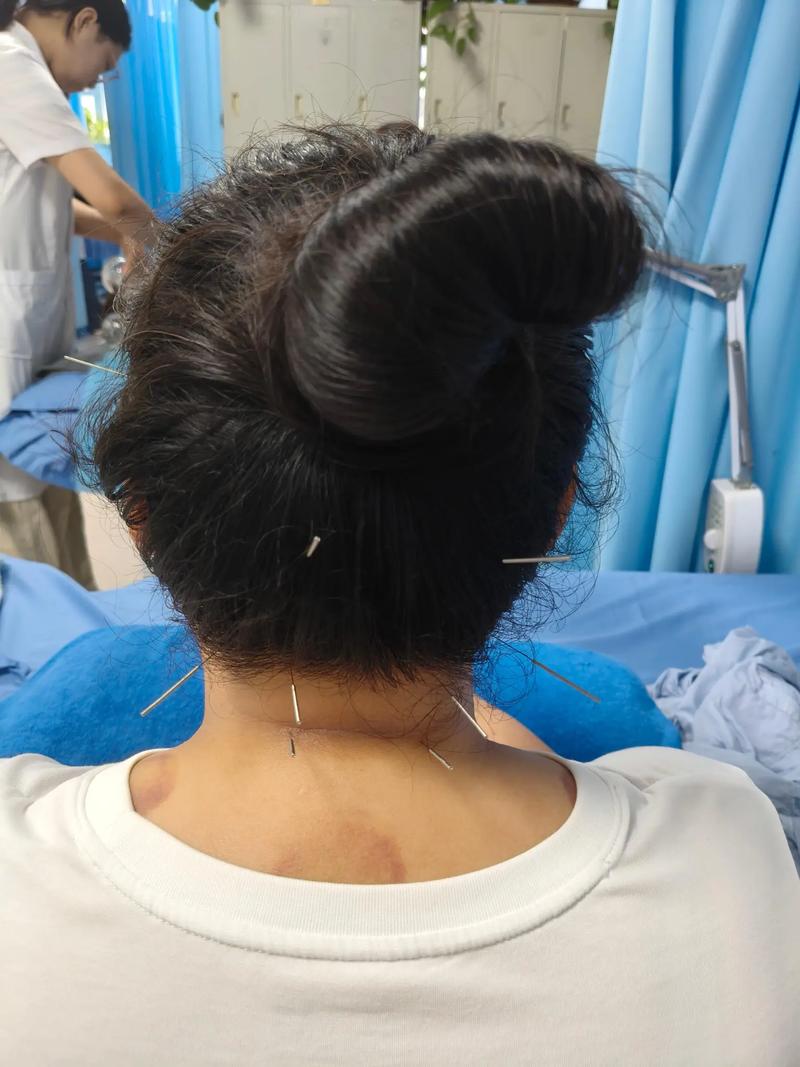 眩晕症针灸哪些穴位