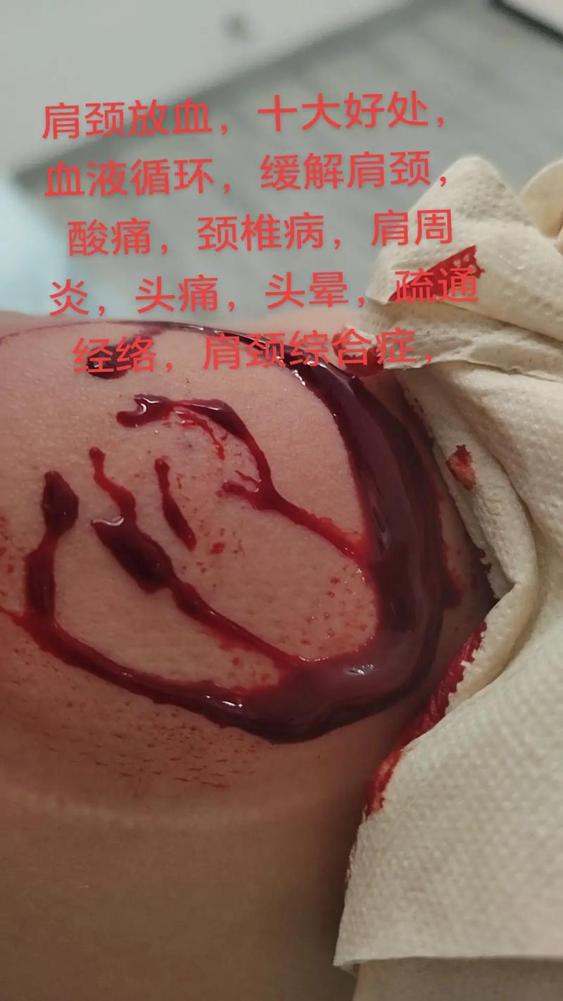 风湿肩周炎拔罐有用吗