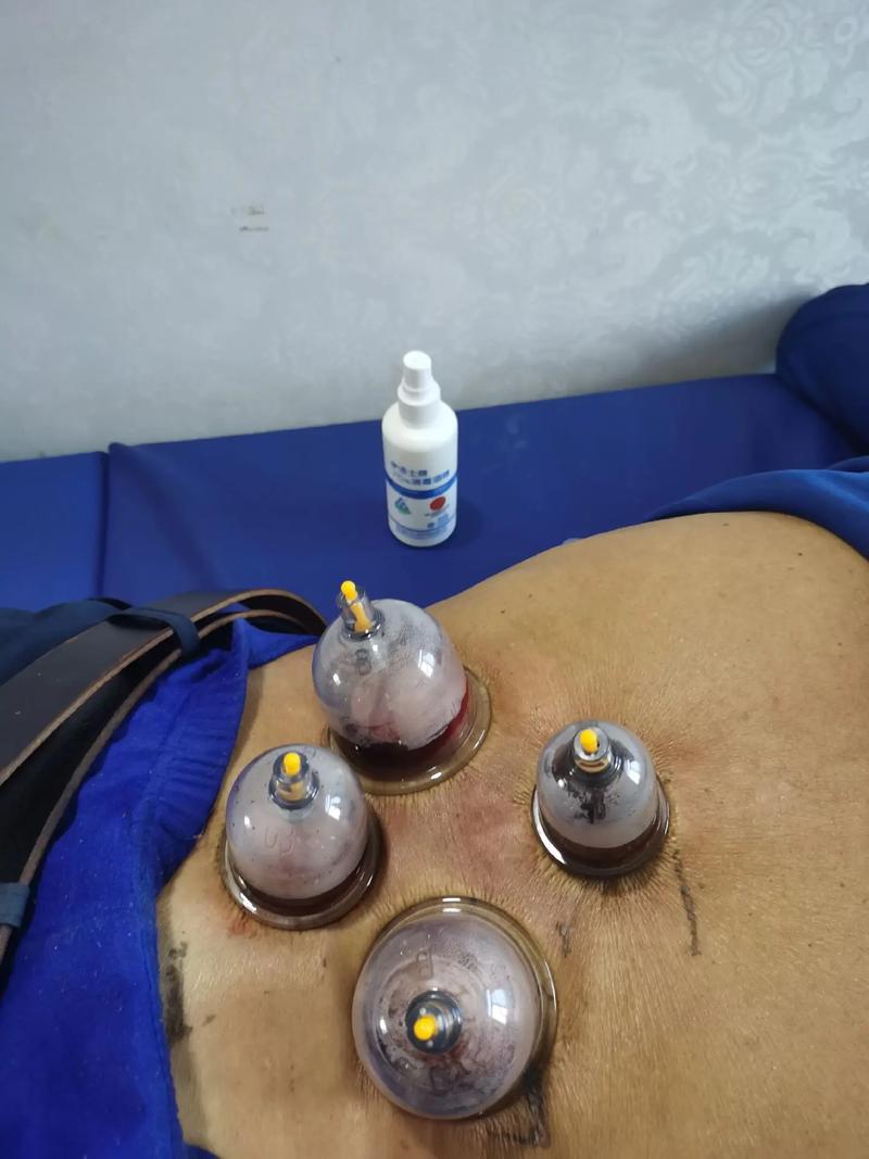 风湿肩周炎拔罐有用吗