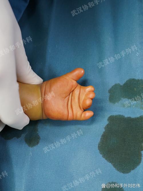 幼年类风湿预后怎么样