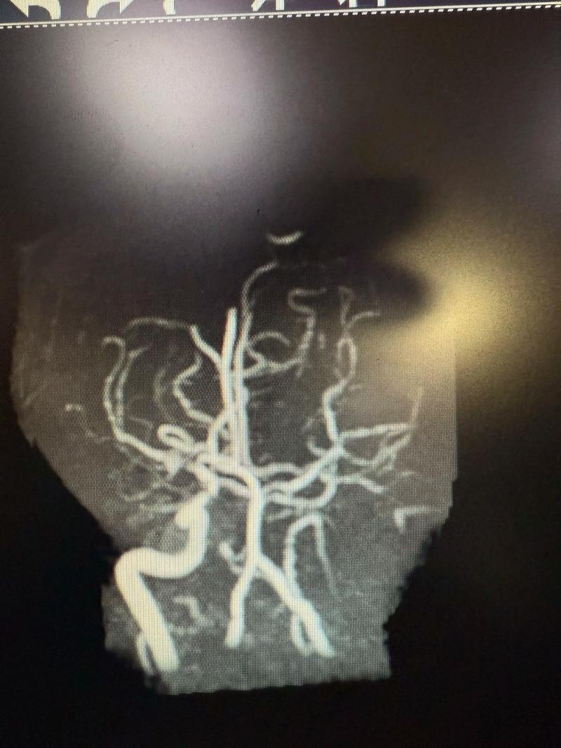 脑梗做支架多久能出院
