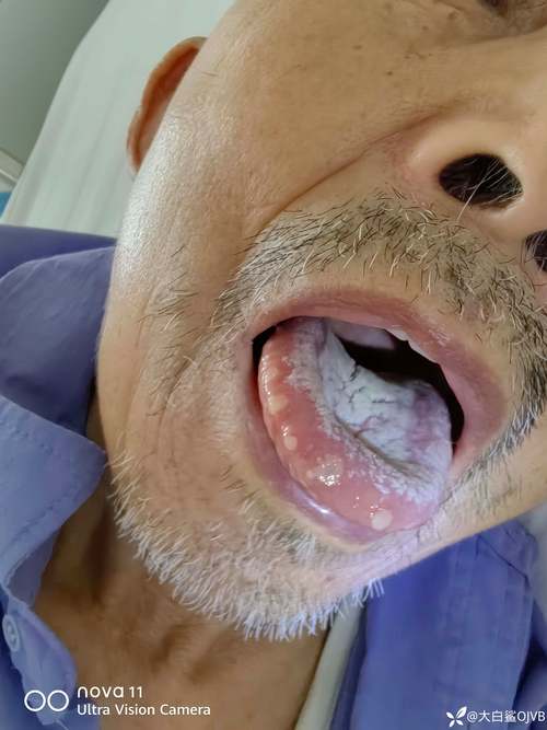 类风湿患者会口腔溃疡