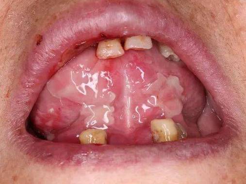 类风湿患者会口腔溃疡