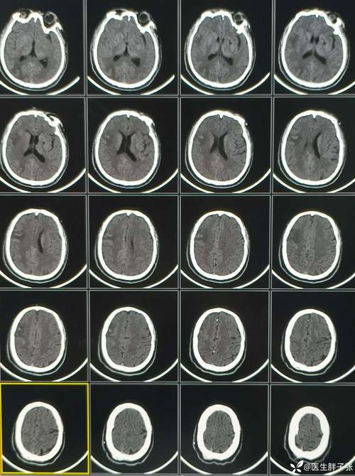 脑梗中线结构左侧移位