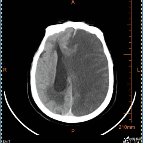 脑梗中线结构左侧移位