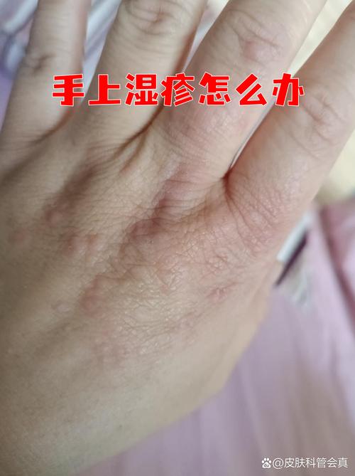 风湿疙瘩可以有盐擦吗