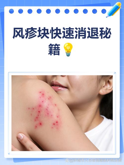 风湿疙瘩可以有盐擦吗