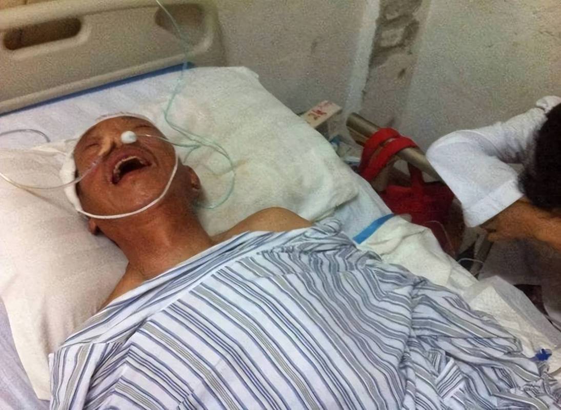 脑梗病人瘫痪肢体肿胀