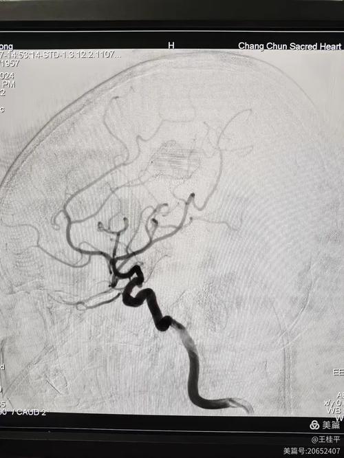 脑动脉血管瘤术 脑梗