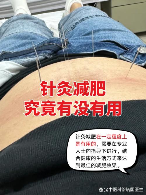 穴位减肥广东总代理