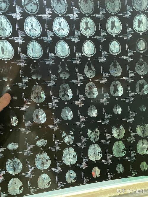 左脑脑梗的人是傻子吗