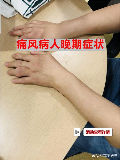 风湿病严重会不会瘫痪