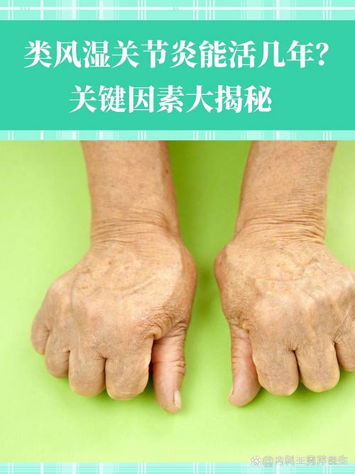 免疫风湿病有哪些症状