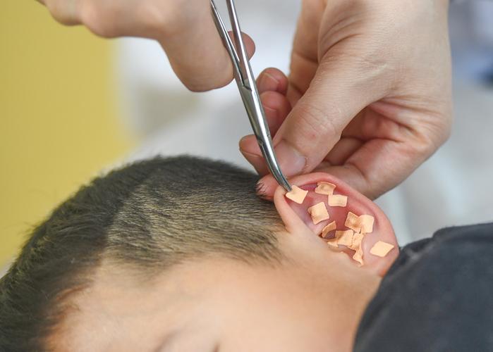 儿童耳针贴什么穴位