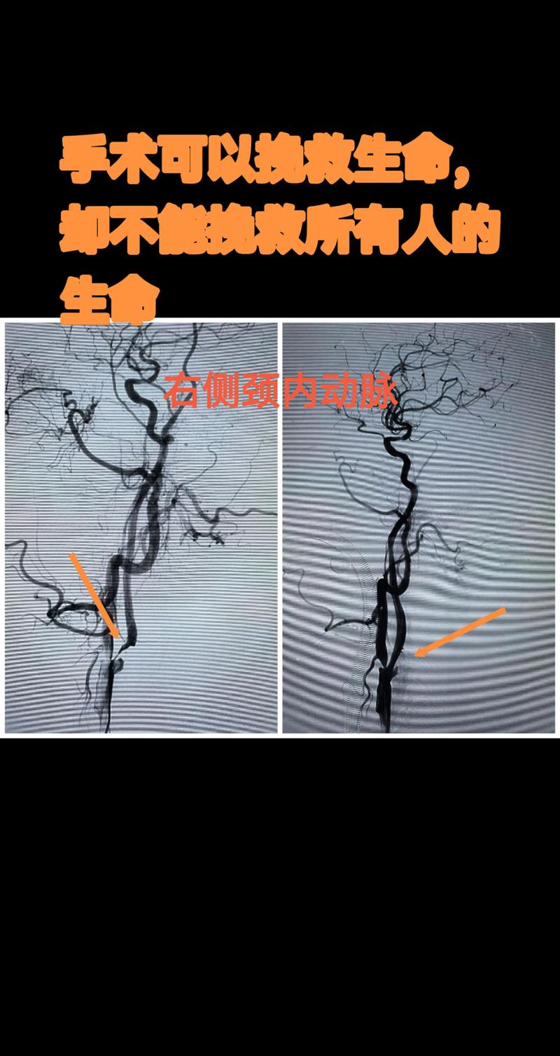 脑动脉瘤介入术后脑梗