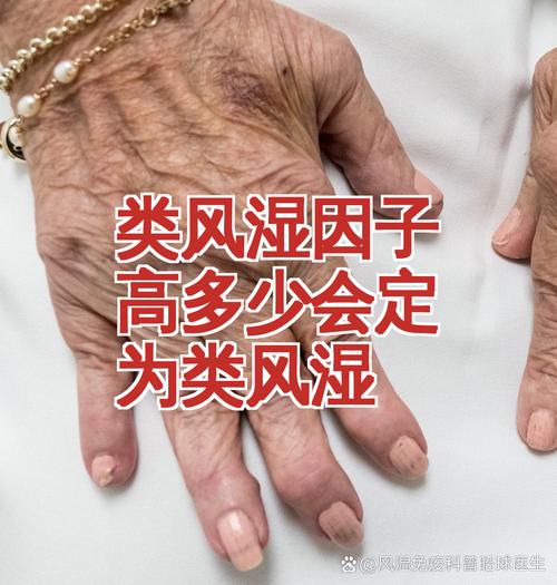 类风湿因子高能降低吗