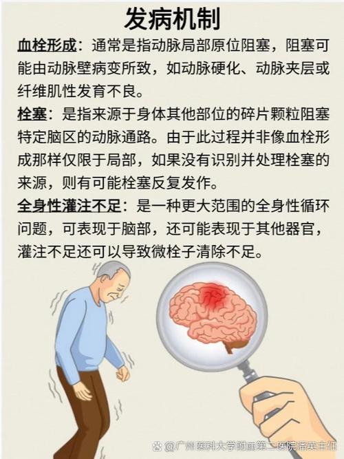 脑梗不能说话能治好吗