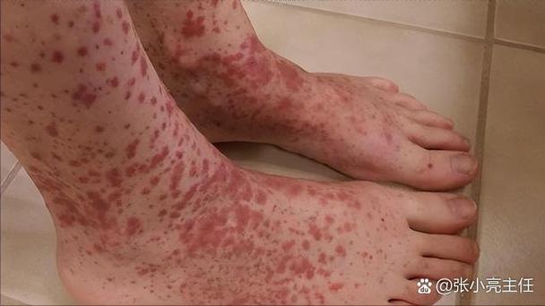 风湿性血小板减少症状