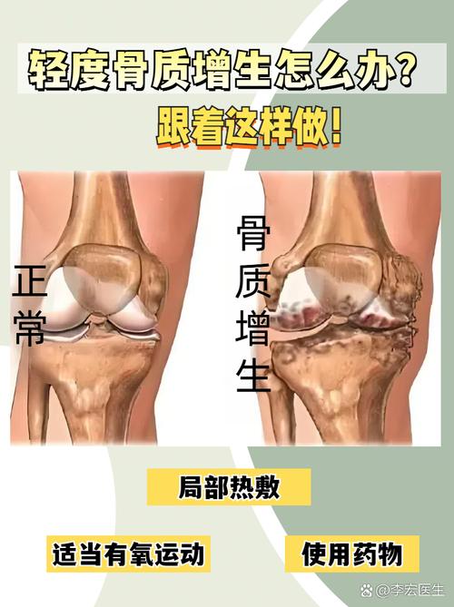 风湿和骨质增生的区别