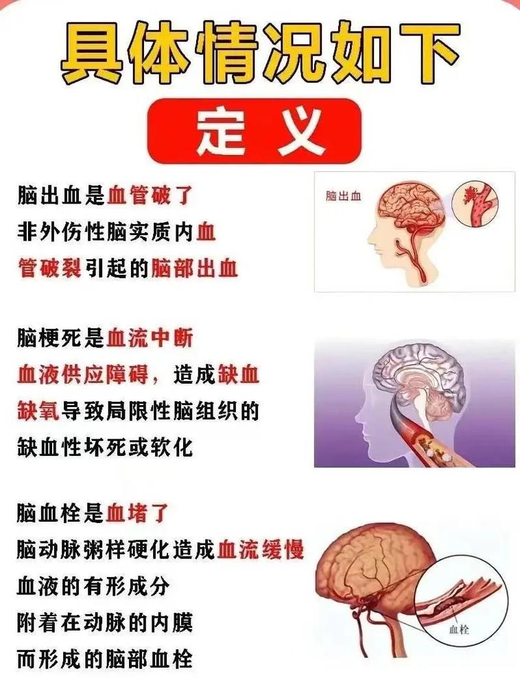 高血压引起的脑梗中风