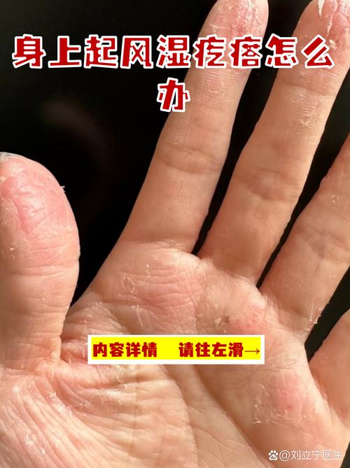 频繁出风湿疙瘩怎么办