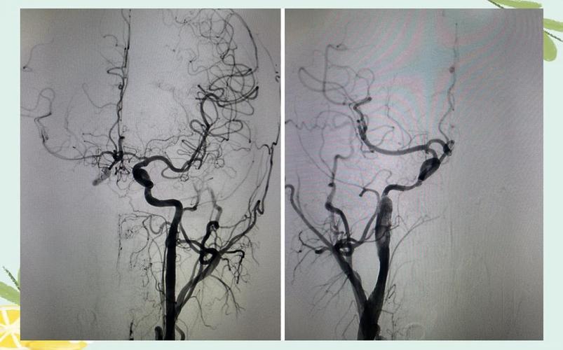 蚌埠哪家医院看脑梗好