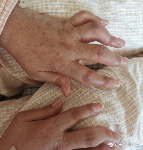 手指风湿病早期的症状
