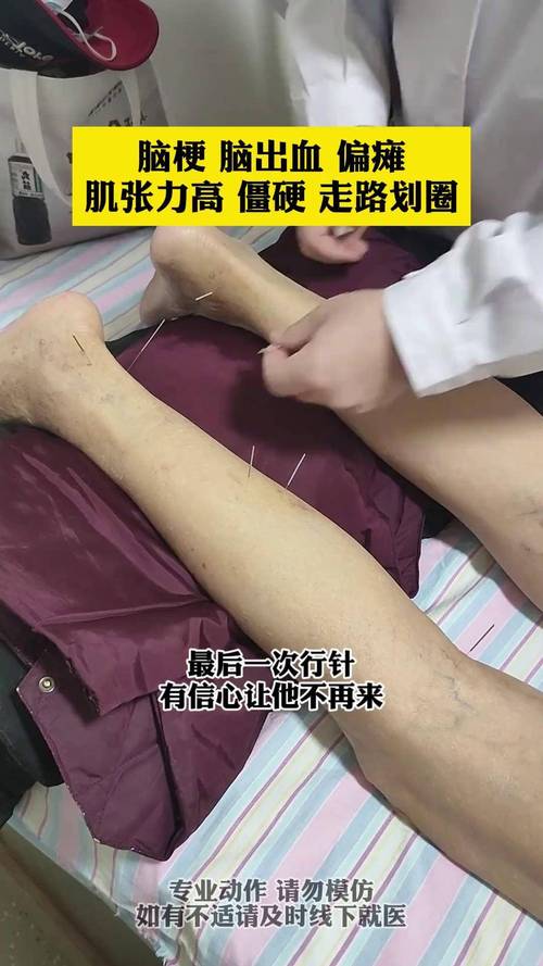 针灸治疗脑血管穴位