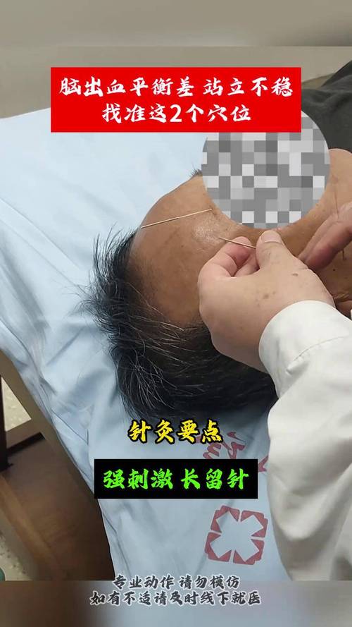 针灸治疗脑血管穴位