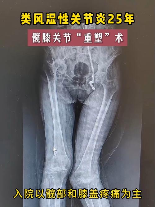 哈尔滨医大二院类风湿