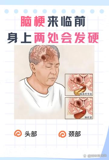 脑梗一定会有后遗症吗