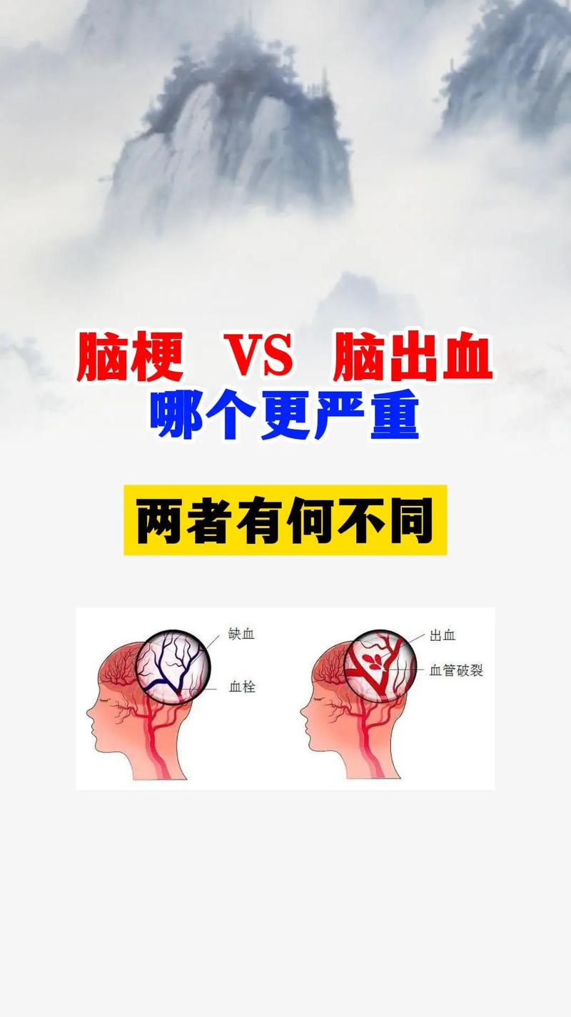 脑梗和脑出血的鉴别表