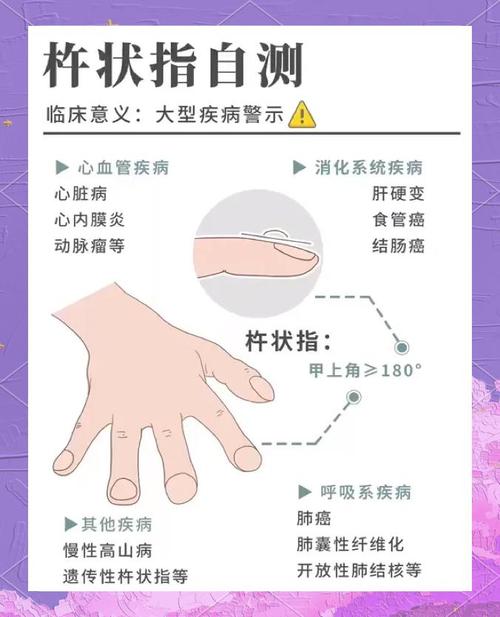 手指风湿变形怎么治疗