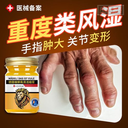 手指风湿变形怎么治疗