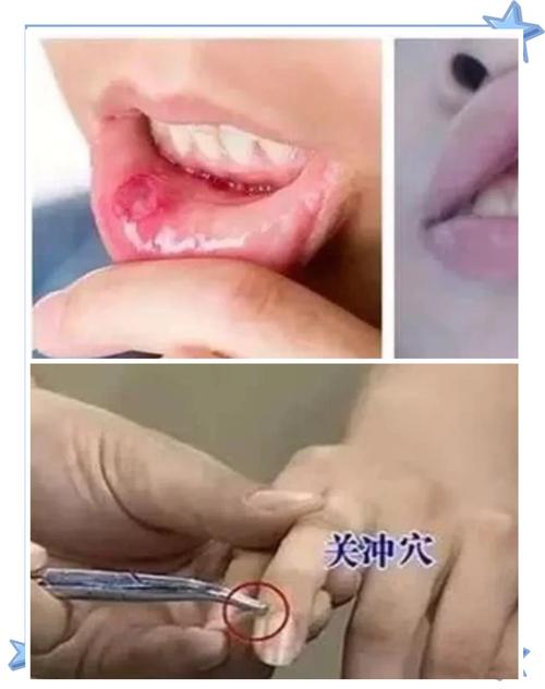 舌头溃疡扎什么穴位