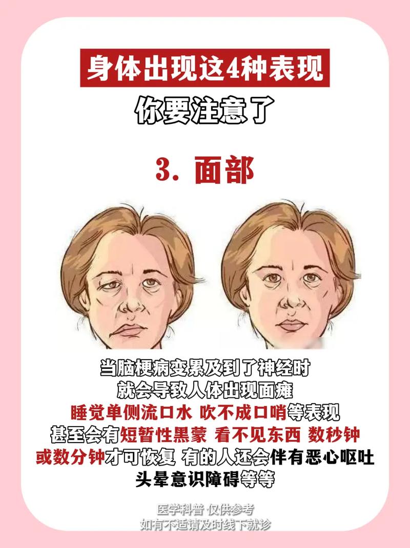 脑梗反复发作怎么回事