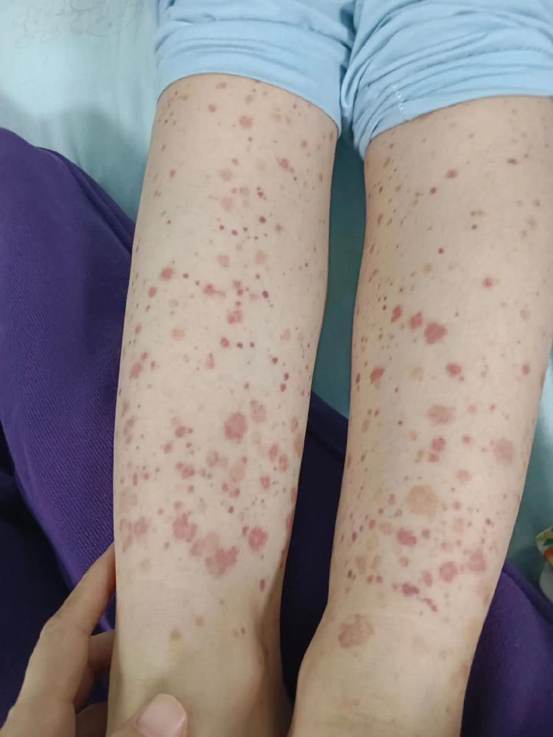 儿童血风湿有什么症状