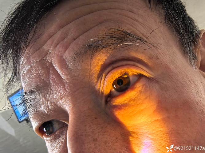 脑梗引起的眼睛看不见