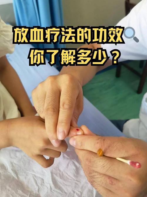 穴位放血快速降血压
