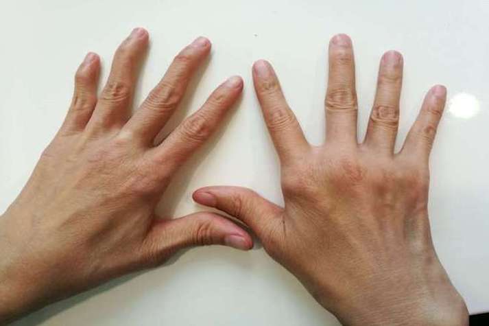 风湿的早期症状有哪些