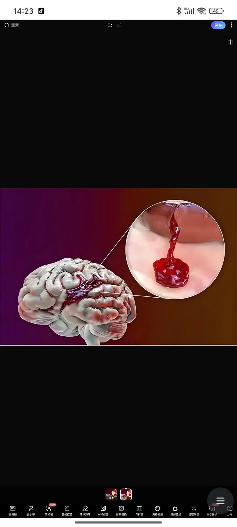 脑梗和脑出血同时存在