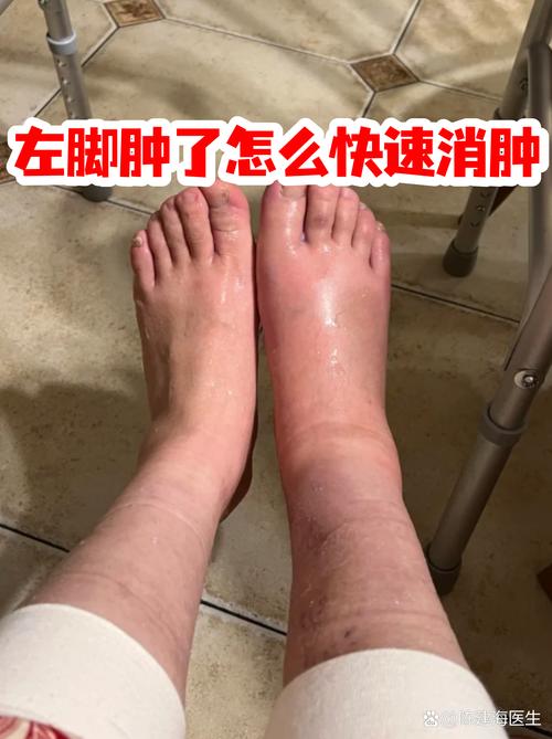 脑梗脚肿怎么快速消肿