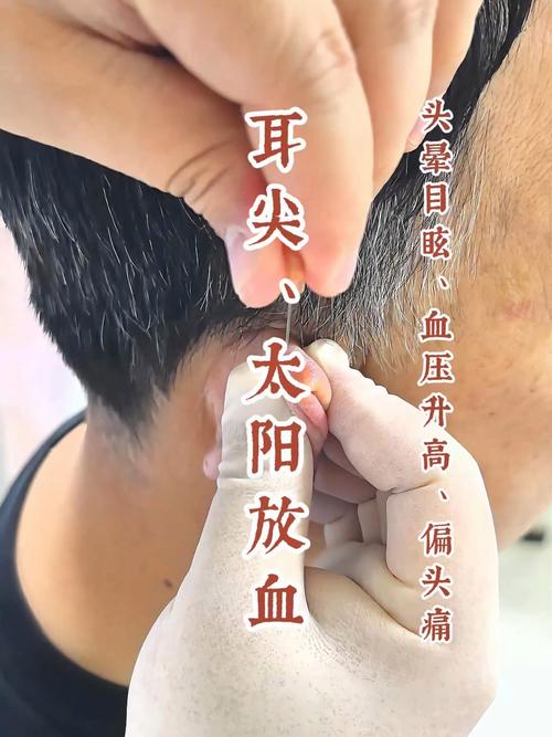 放血疗法的穴位视频