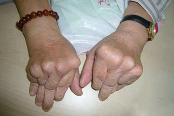 得了风湿的症状是什么